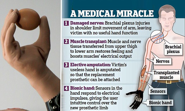 bionic arm graph